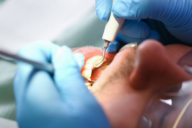 Best Emergency Root Canal Therapy in Sutherland, NE